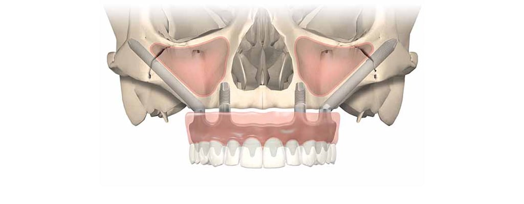 All-On-4 South Shore Oral Surgery Associate in Quincy Zygomatic implant