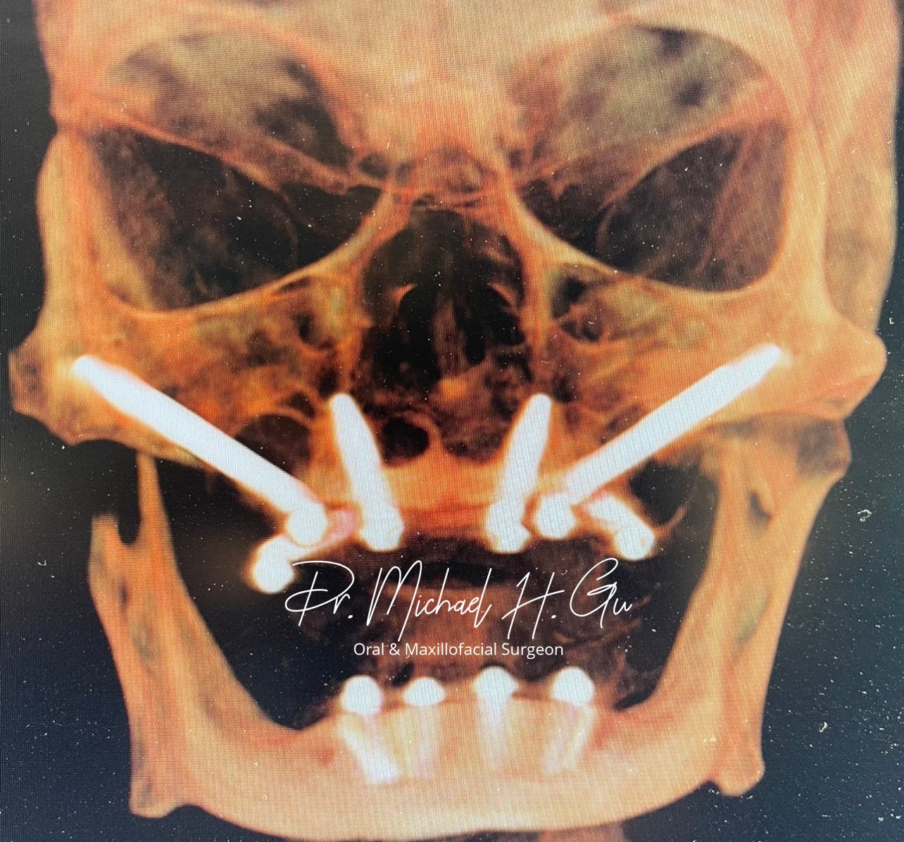 South Shore Oral Surgery Dr Gu Zygomatic implant